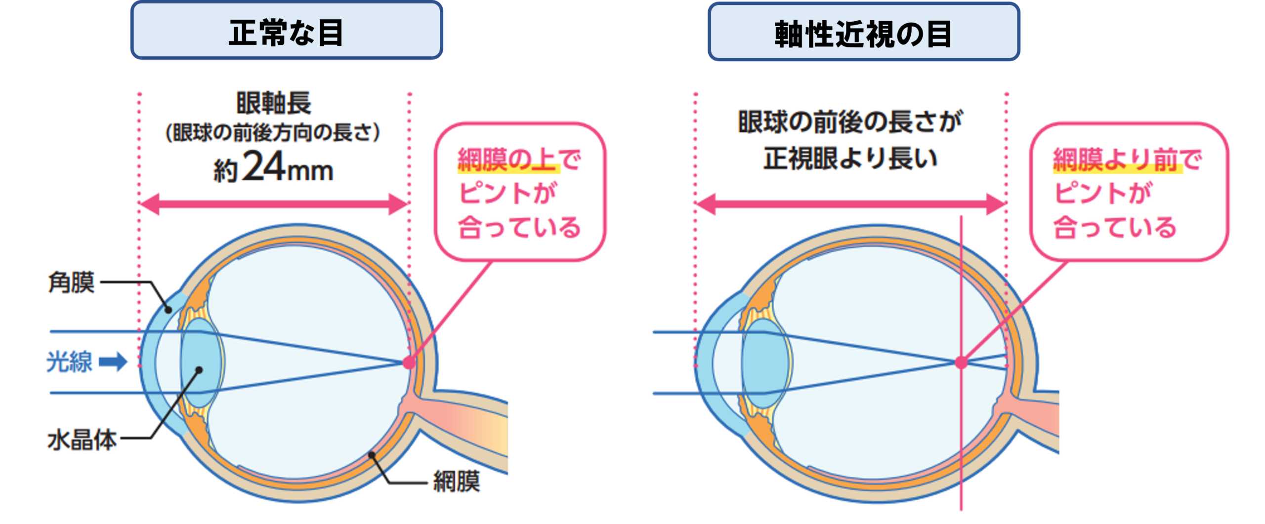 近視のしくみ