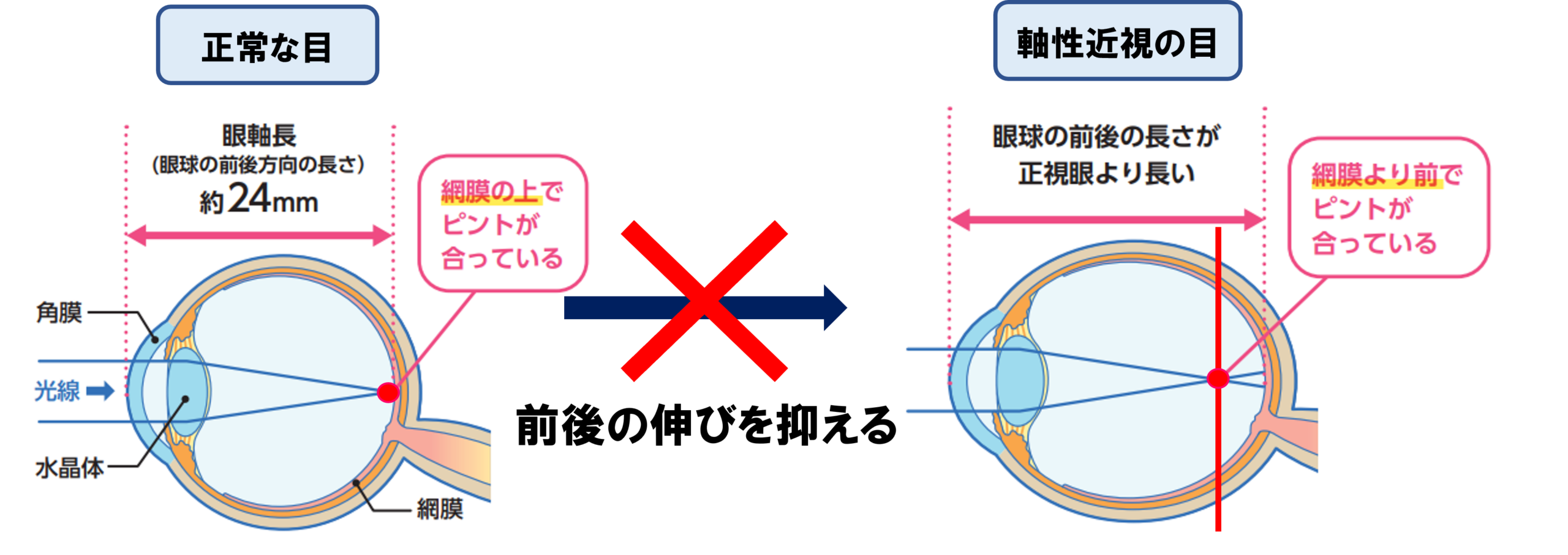 近視抑制の仕組み